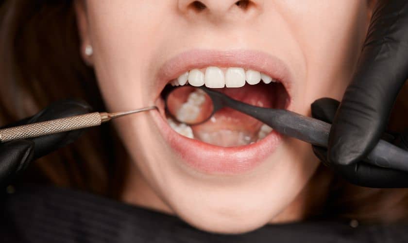 Key Differences Between Tooth-Colored Fillings And Traditional Metal Fillings