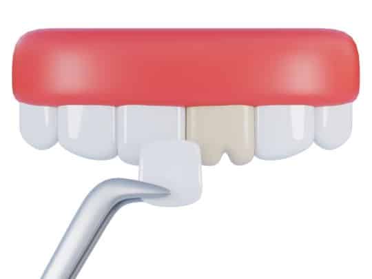 dental veneers on chipped tooth