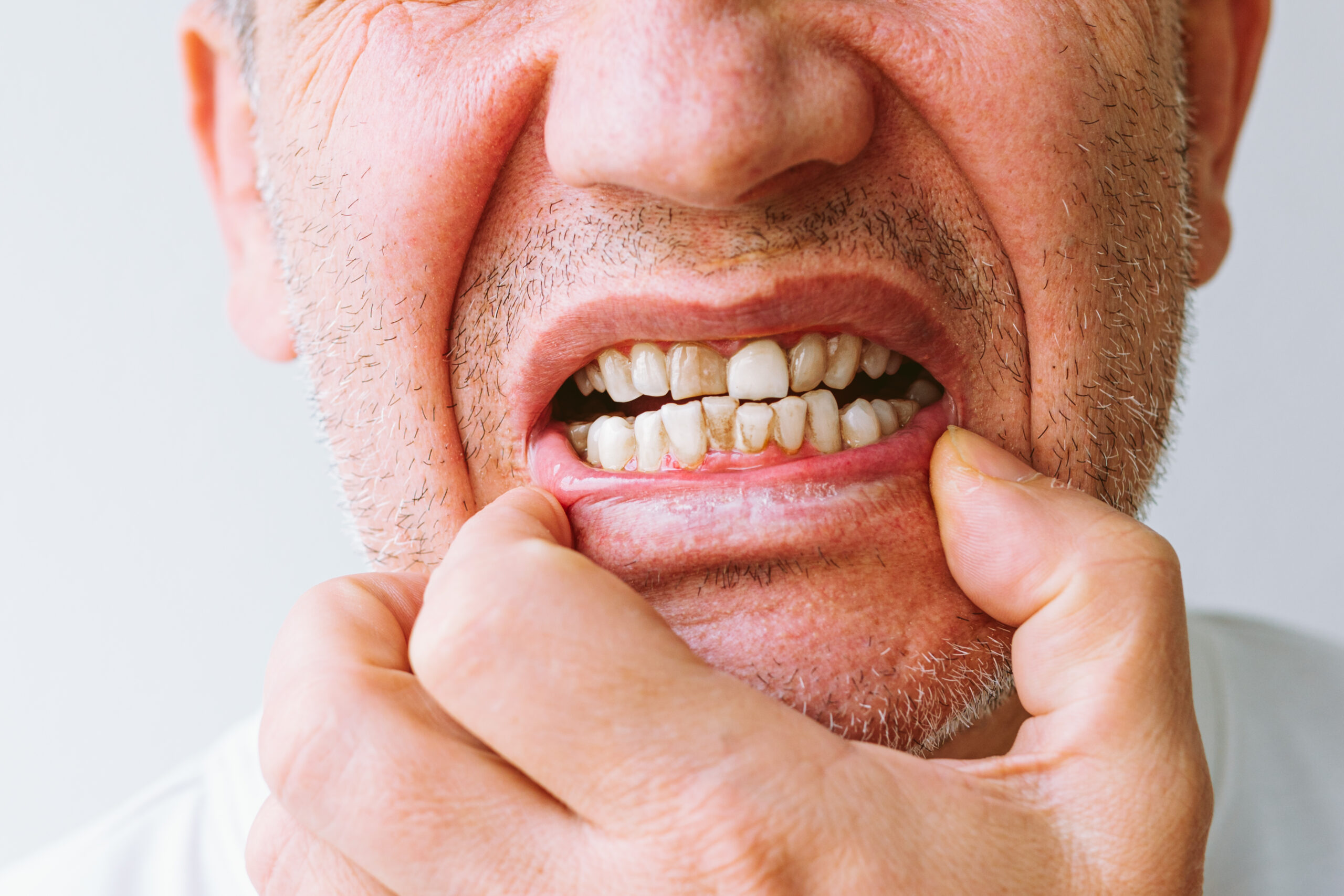 Close-up of a man pulling down his lower lip to show brown stains and buildup on teeth near the gumline