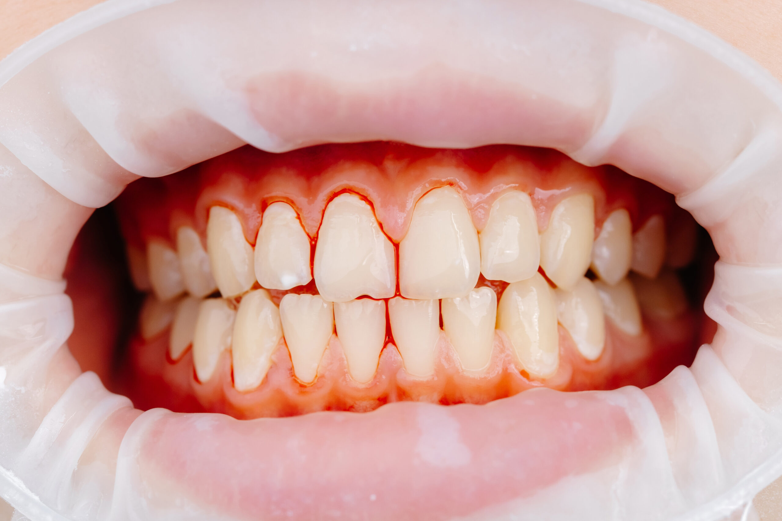 Close-up view of inflamed, bleeding gums around teeth, showing early signs of gum irritation and gingivitis