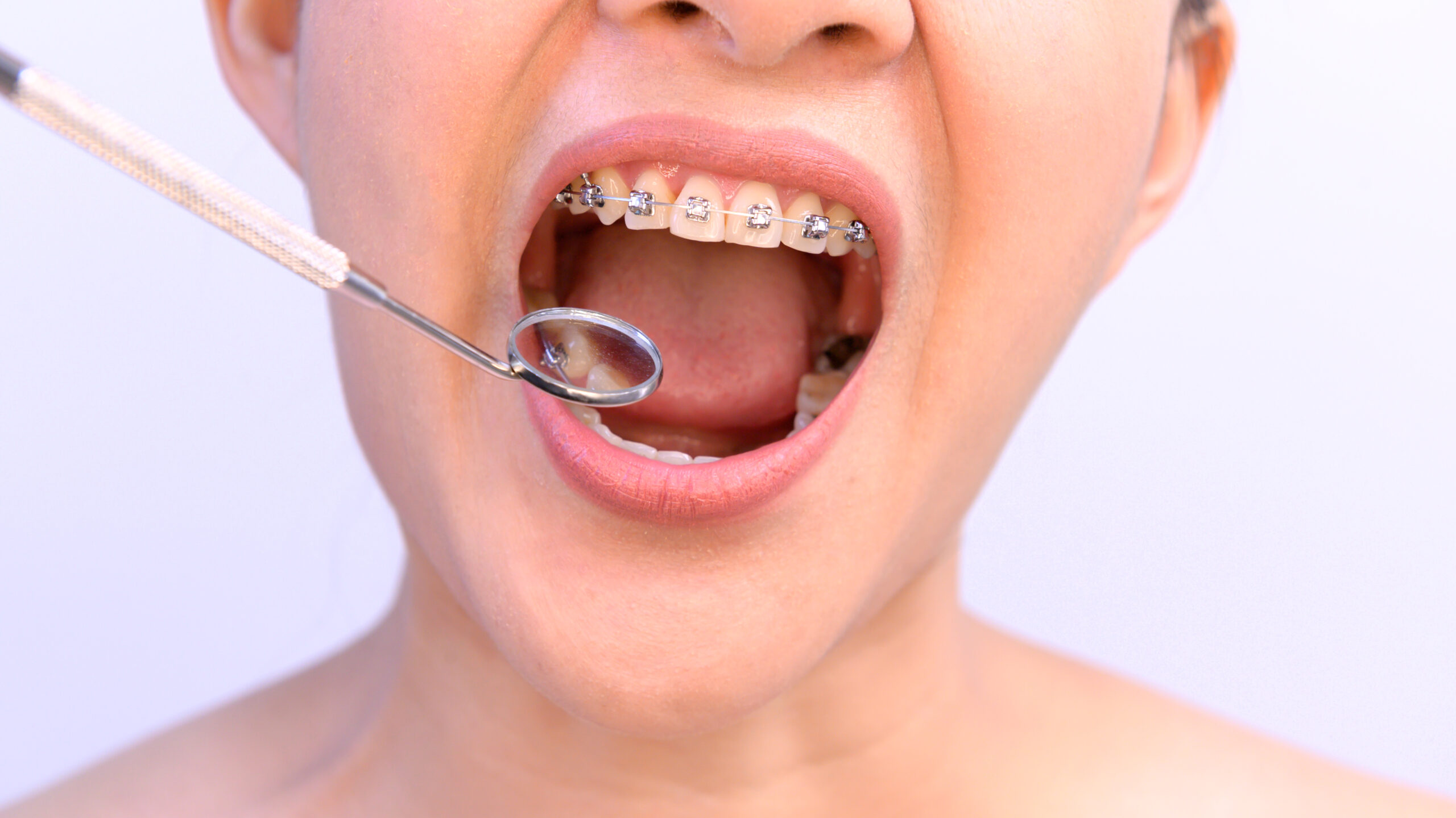 Close-up of a patient with braces during a dental checkup, showing orthodontic brackets and mirror examination inside the mouth