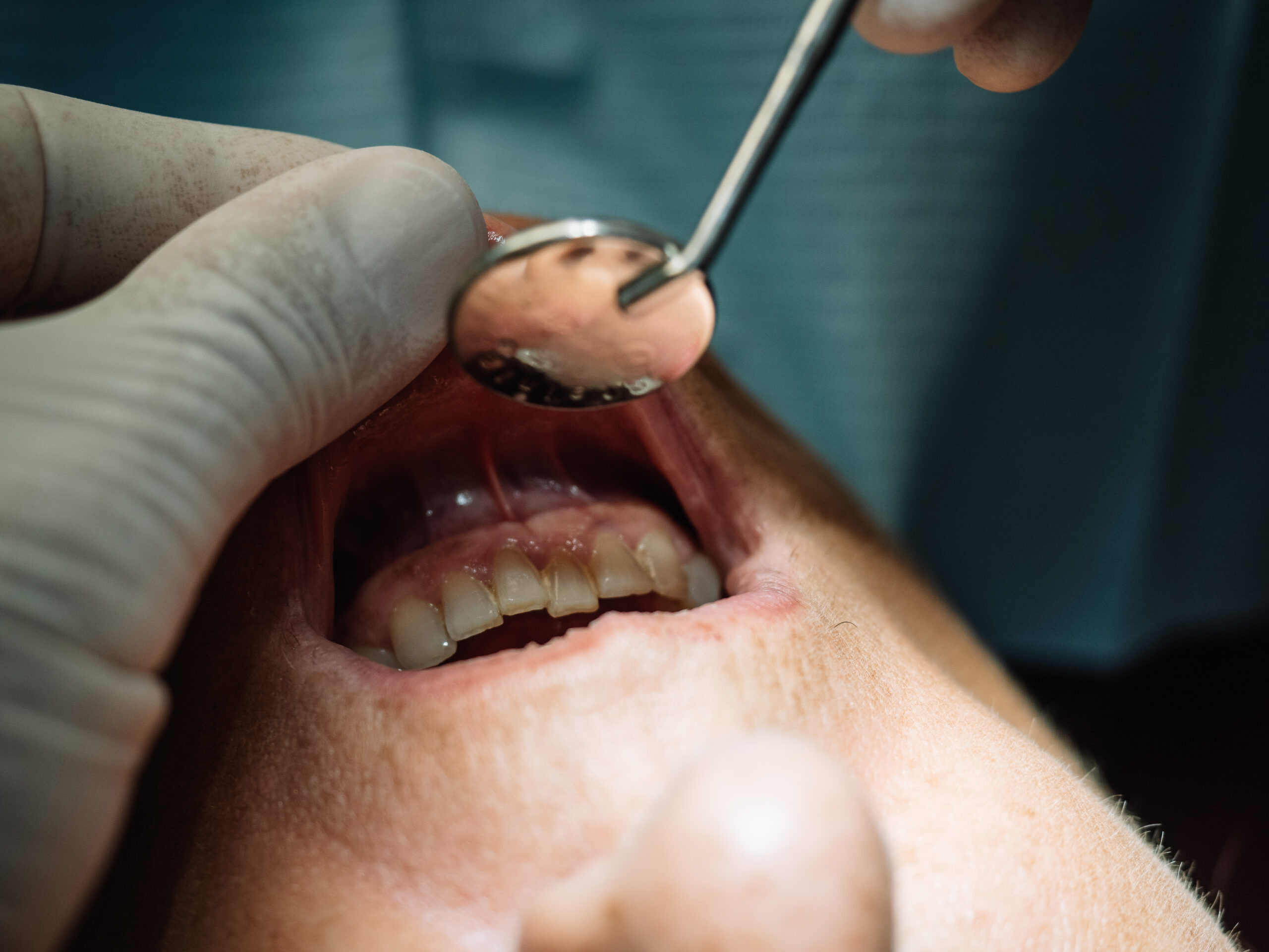 Close-up of a dentist examining slightly misaligned front teeth using a dental mirror during a routine checkup.
