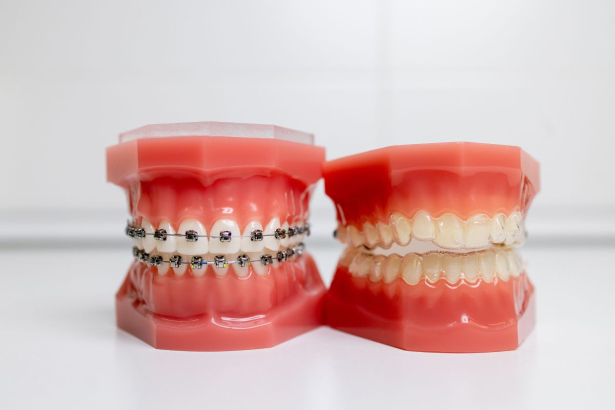 Dental models showing braces and clear aligners for crowded teeth treatment