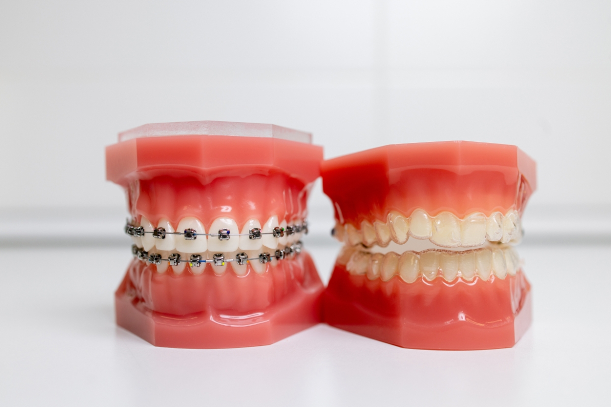 Braces and clear aligners showing modern orthodontic treatment options